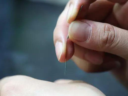 三棱針療法治療高燒嗎？